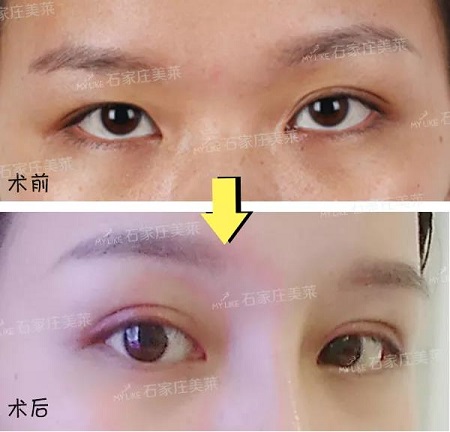 明星的眼和鼻，術后半個月Get專業混血臉！可萌可酷美翻了~