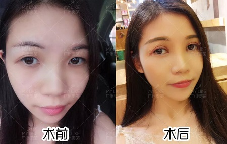 天生雙眼皮卻不好看？原因原來出在這！