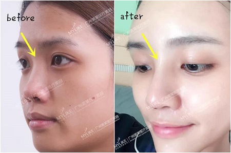 五官精致度欠缺？玻尿酸10分鐘救回來！