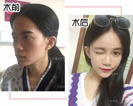 脂肪填一填，臉竟從“喪到爆”變“萌出血”！
