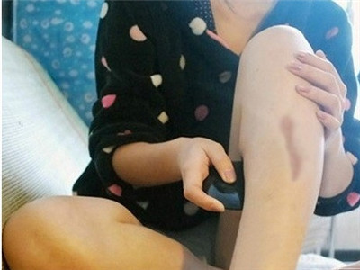 武漢激光去疤痕的方法一般要多少錢?