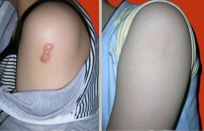 武漢激光去疤痕的方法一般要多少錢?