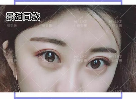 割個雙眼皮，居然成景甜2.0？