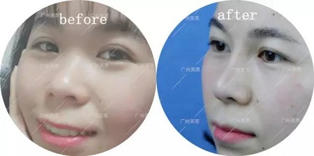 打了2支玻尿酸，她到底變啥樣了？