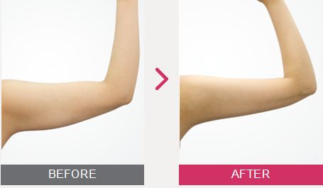武漢手臂吸脂減肥多少錢?