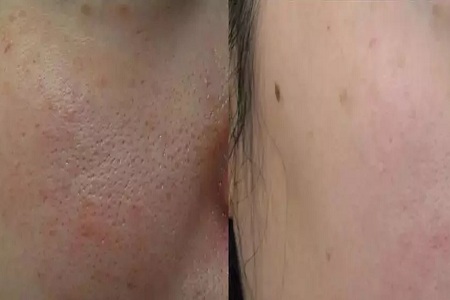 彩光嫩膚收縮臉上毛孔效果怎么樣