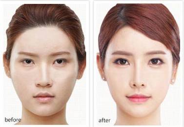 深圳做埋線雙眼皮的價格具體是多少?