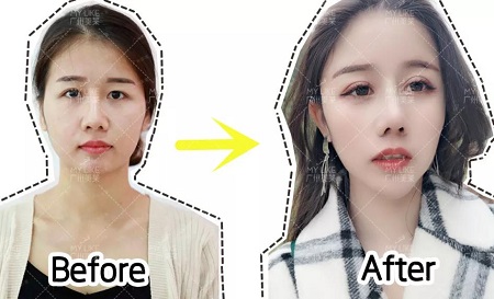 換對鼻子宛如換了一張臉,大媽臉秒變神仙顏!