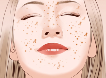 南京激光去雀斑的價(jià)格是多少?