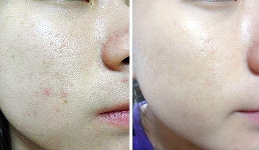 天津彩光嫩膚效果怎么樣?