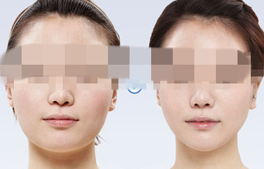 適合面部吸脂整形的人多嗎?