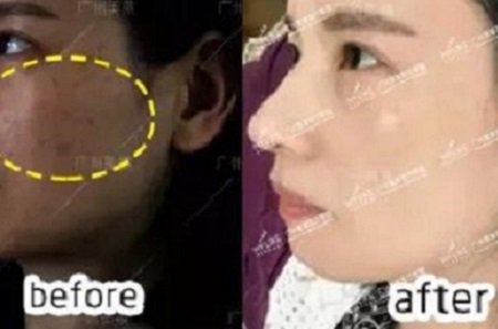 祛斑30天,蛻變日記!
