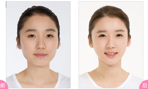 武漢臉部吸脂多少錢?