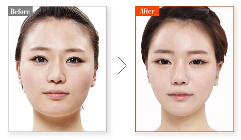 寧波瘦臉一般多少錢？