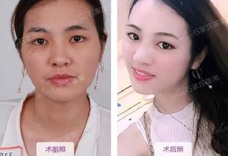 這幾種臉型妹紙,千萬別做面部脂肪填充!!!