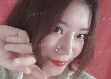 “扁塌鼻”都是潛力股，做完鼻整形，顏值逆風翻盤！