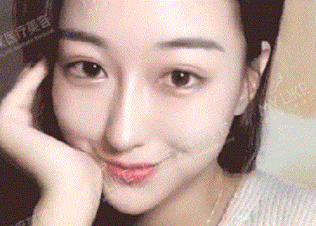 隆鼻害怕假、僵、歪？案例親測(cè)示范捏鼻！