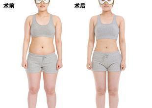 天津全身吸脂手術價格是多少錢?