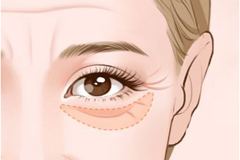 深圳做眼部去脂容易嗎?