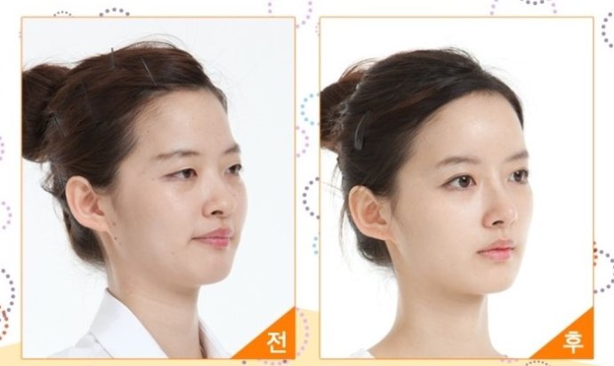 廣州鼻尖整形價格是多少錢?