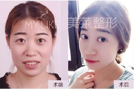 這幾種眼睛割完雙眼皮超美!不信,看她們的術(shù)后效果~