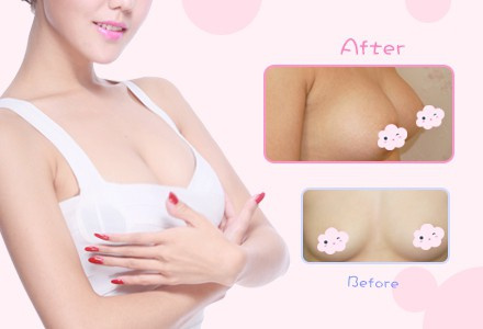 天津內窺鏡隆胸多少錢？