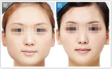 武漢面部吸脂減肥價(jià)格?