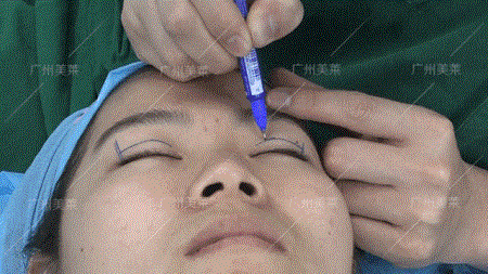 這6種眼睛，割了5天就有換頭般效果！