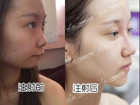 5個案例告訴你，玻尿酸即刻效果多明顯？！