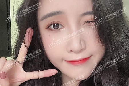 脂肪填充21天,蛻變全日記!