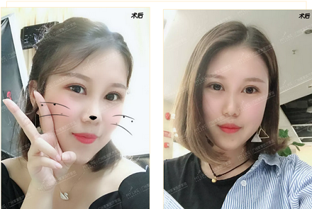 雙眼皮貼10年，割1刀，美20倍！