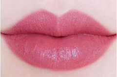 杭州注射玻尿酸豐唇維持多久？