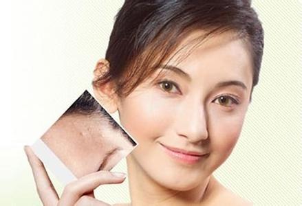 廣州激光祛痘印要多少錢?