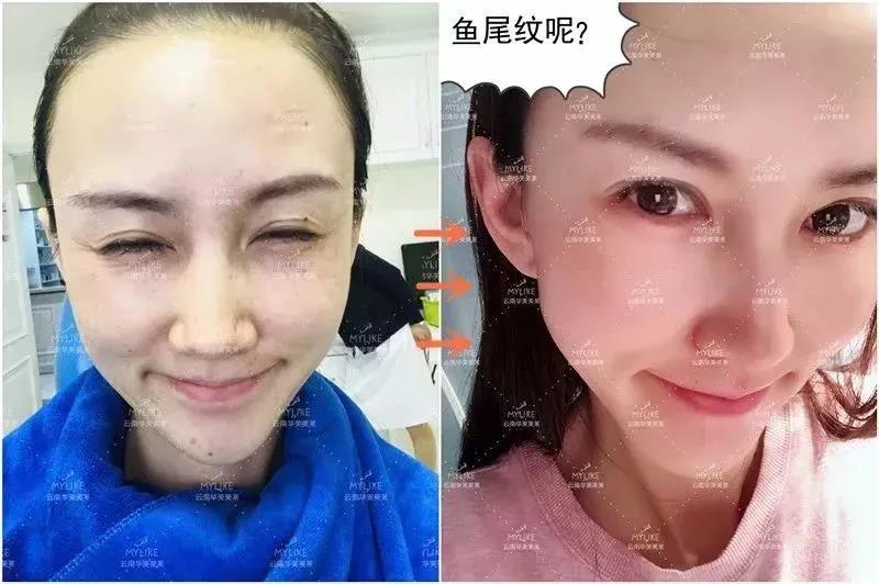 玻尿酸瘦臉打夠次數就能瘦下來，除皺打夠次數也能一直保持嗎？