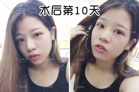 割雙眼皮后都可以出道了!