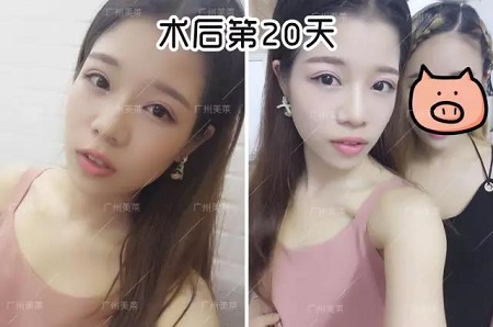 割雙眼皮后都可以出道了!