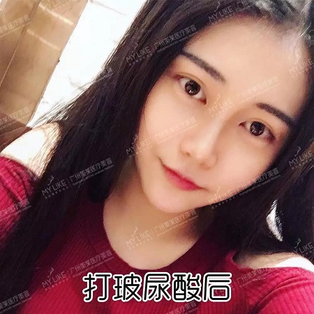 玻尿酸打這3個部位，立即換張臉！