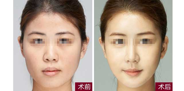 瘦臉一針需要多少錢?