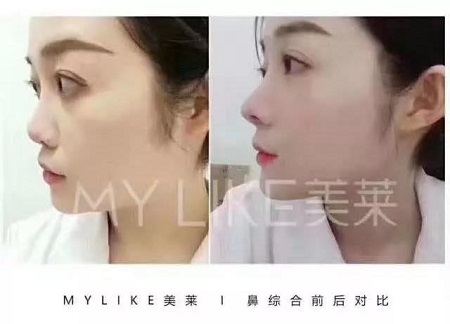 做鼻整形要謹記這些“后遺癥”！