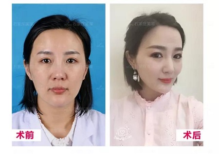 松弛的臉做完*雕,比同齡人足足年輕10歲!