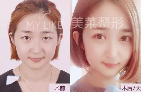 美萊特邀“美眼女神”畢小麗,3月13日親診石家莊美萊。