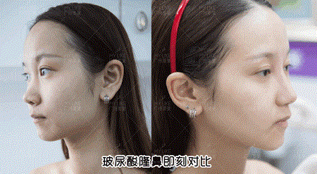 隆鼻價格內幕曝光!水超深!