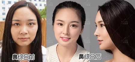 隆鼻價格內幕曝光!水超深!