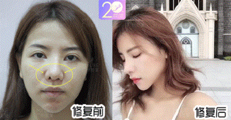 深扒 | 隆鼻價格內幕曝光!水超深!