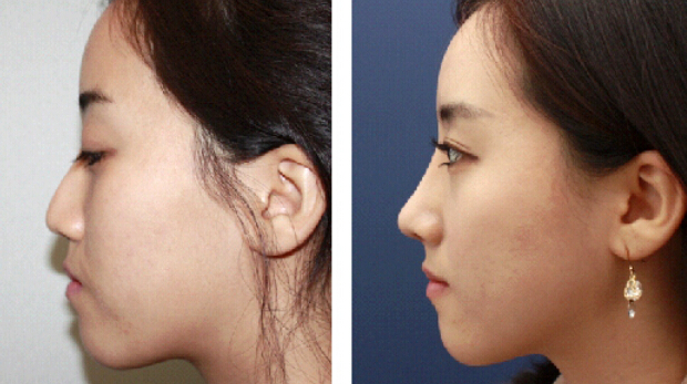 假體隆鼻加玻尿酸哪個好?