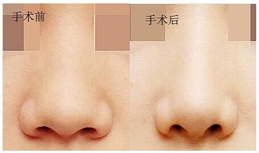 鼻孔縮小術(shù)要多少錢?