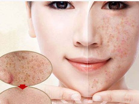 點斑需要多少錢?