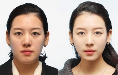 改臉型需要多少錢?