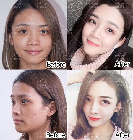 臉凹？面扁？鼻塌？沒下巴？幾支玻尿酸全搞定！