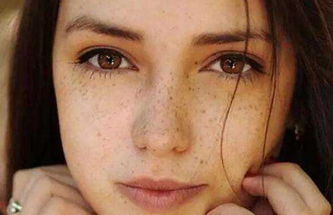 激光去除雀斑的方法要多少時間恢復正常?